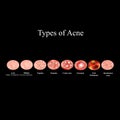 Types of Acne Skin inflammation. Pimples, boils, whitehead, closed comedones, papules, pustules, cystic acne