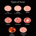 Types of Acne Skin inflammation. Pimples, boils, whitehead, closed comedones, papules, pustules, cystic acne Royalty Free Stock Photo