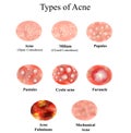 Types of Acne Skin inflammation. Pimples, boils, whitehead, closed comedones, papules, pustules, cystic acne Royalty Free Stock Photo