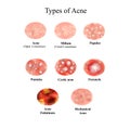 Types of Acne Skin inflammation. Pimples, boils, whitehead, closed comedones, papules, pustules, cystic acne Royalty Free Stock Photo