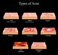Types of Acne Skin inflammation. Pimples, boils, whitehead, closed comedones, papules, pustules, cystic acne Royalty Free Stock Photo