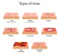 Types of Acne Skin inflammation. Pimples, boils, whitehead, closed comedones, papules, pustules, cystic acne