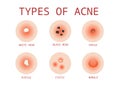6 Types of Acne, Vector