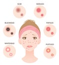 Types of acne and woman face illustration. whitehead,black head, papules, and pustules. Beauty skin care concept