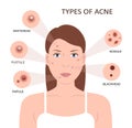 Types of acne. Woman with Pimples