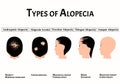Types of alopecia. Bald spot, baldness, Alopecia mesotherapy. Causes of baldness. Infographics. Vector illustration on