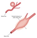 Types of aneurysm