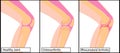 Types of arthritis Knee medical vector illustration