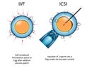 Types of artificial fertilization of the egg by sperm ECO und ICSI