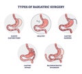 Types of bariatric surgery and stomach reduction control outline diagram