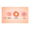 Types of blackheads, pustule, acne. Scarred skin after acne and acne. Infographics. Vector illustration on isolated