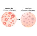 Types of blackheads, pustule, acne. Scarred skin after acne and acne. Infographics. Vector illustration on isolated