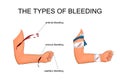 The types of bleeding