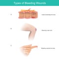 Types of Bleeding Wounds.