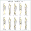 Types of bone fractures medical educational vector Royalty Free Stock Photo