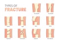 types of bones fractures, bones fracture classification