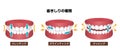 Types of bruxism teeth grinding vector illustration