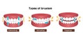 Types of bruxism teeth grinding vector illustration