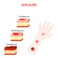 Types of burns. Cross section of humans skin Royalty Free Stock Photo