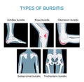 Types of bursitis. monochrome flat vector like x-ray illustration
