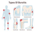 Types of bursitis set. Shoulder, hip, heel, knee and elbow joints inflammation.