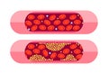 Types of cholesterol. HDL and LDL cholesterol types. Labeled educational normal and narrowed artery. Vector illustration