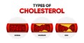 Types Cholesterol. LDL and HDl level. Arteriosclerosis, infarct, ischemia, thrombosis disease. Cholesterol in human