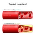 Types of cholesterol. Normal and narrowed artery Royalty Free Stock Photo