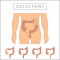 Types of colectomy Royalty Free Stock Photo