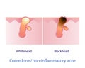 Types of comedone, non inflammatory acne vector on white background. Royalty Free Stock Photo