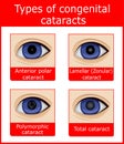 Types of congenital cataracts