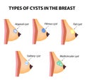 Types of cysts in the breast. Atypical, Fibrous, Fatty cyst, Solid cyst, Multicameral. World Breast Cancer Day. Tumor. Set. Vector