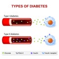 Types of Diabetes