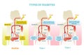 Types of diabetes vector illustration diagram scheme