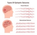 Types of epilepsy. Generalized and focal seizures. Human brain