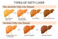 Types of fatty liver. Human liver diseases. Alcoholic and non-alcoholic fatty liver. Hepatitis, liver cirrhosis, fibrosis