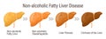 Types of fatty liver. Human liver diseases. Non-alcoholic fatty liver disease.Medical infographic banner. Vector