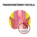 Types of fistulas of the rectum. Paraproctitis. Anus. Abscess of the rectum. Infographics. Vector illustration