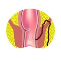 Types of fistulas of the rectum. Paraproctitis. Anus. Abscess of the rectum. Infographics. Vector illustration Royalty Free Stock Photo