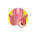 Types of fistulas of the rectum. Paraproctitis. Anus. Abscess of the rectum. Infographics. Vector illustration