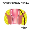 Types of fistulas of the rectum. Paraproctitis. Anus. Abscess of the rectum. Infographics. Vector illustration
