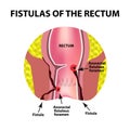 Types of fistulas of the rectum. Paraproctitis. Anus. Abscess of the rectum. Infographics. Vector illustration