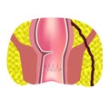 Types of fistulas of the rectum. Paraproctitis. Anus. Abscess of the rectum. Infographics. Vector