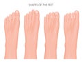 Types of the forefoot and toes