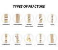 Types of fracture. Fracture bone set. Infographics. Vector illustration on isolated background.
