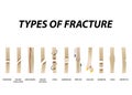 Types of fracture. Fracture bone set. Infographics. Vector illustration on isolated background. Royalty Free Stock Photo