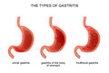 The types of gastritis