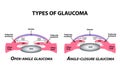 Types of glaucoma. Open-angle and angle-closure glaucoma. The anatomical structure of the eye. Infographics. Vector