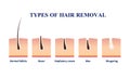 Types Of Hair Removal Illustration