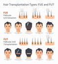 Types of hair transplantation FUE and FUT Royalty Free Stock Photo
